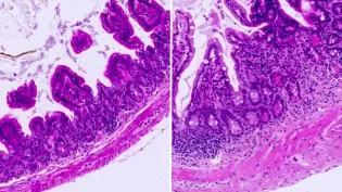 Microscope images from the bowel. Left image shows less inflamed tissue in young bowel; Right image shows ongoing inflamed tissue in older bowel