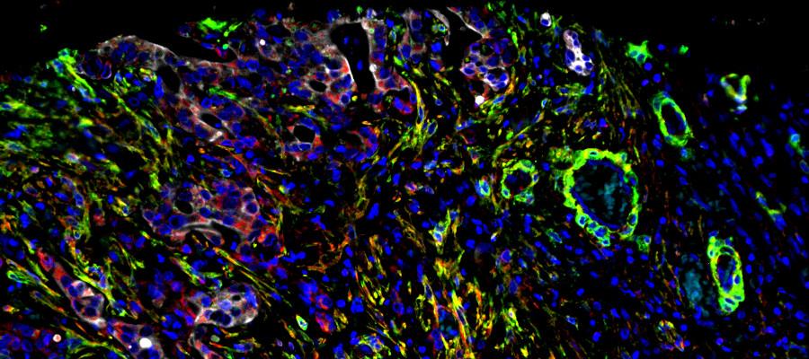 Cholangiocarcinoma microscope image