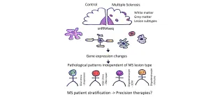 A line drawing of a brain, showing different leasion subtypes which each lead to different pattern of gene expression which separates patients into 4 groups, each with a different pattern of brain cell responses to MS
