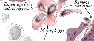 A scientific diagram showing how cell therapy using macrophages interacts with other cells in the liver