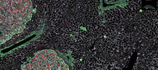 A microscopy image showing tumour cells stained with fluorescent dye.
