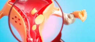 A graphical illustration of a magnifying glass looking at a uterus with cancer growing in it