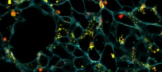 Microscope image of cells (cyan colour) and fluorescent red and yellow dots signifying lysosomes and the drug