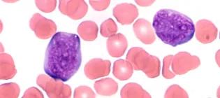 blood cells stained red (red blood cells) and purple (white blood cells)