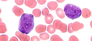 blood cells stained red (red blood cells) and purple (white blood cells)