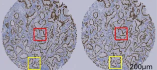 Two circles (patient sample on left and AI-generated image on right). Almost identical, showing blue staining in patterns on tissue