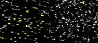 Microscopy image showing small white dots (cells) within a wound site. There is a reduction in wound neutrophil (yellow dots) infiltration in wounds treated with CCL3 blocker (right) compared to those without CCL3 blocker (left).
