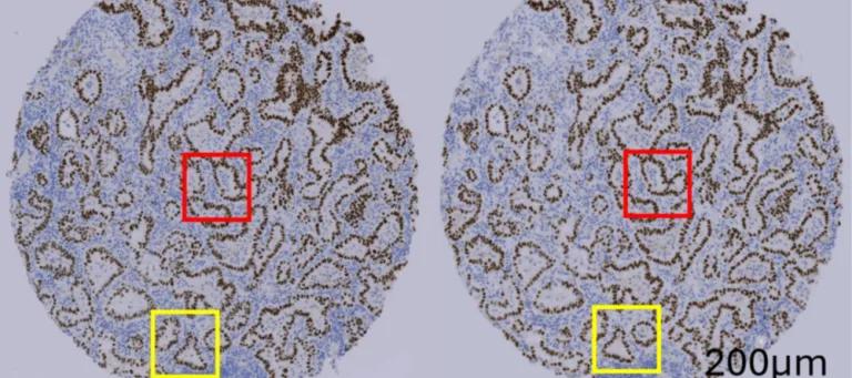 Two circles (patient sample on left and AI-generated image on right). Almost identical, showing blue staining in patterns on tissue