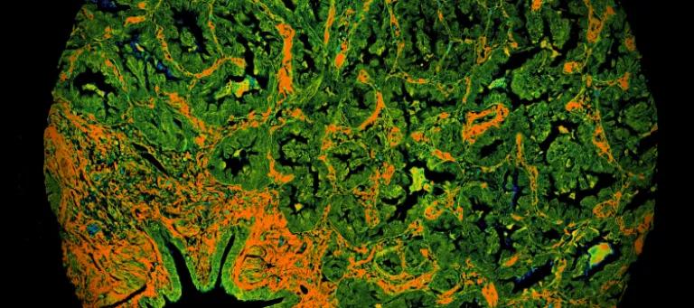 a fluorescent image of lung cancer cells