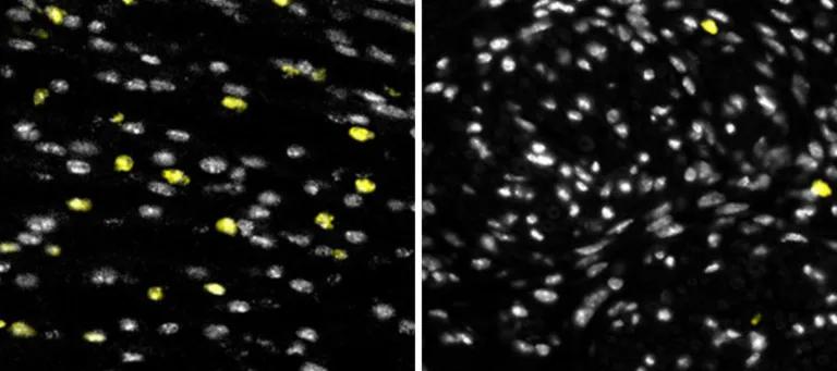 Microscopy image showing small white dots (cells) within a wound site. There is a reduction in wound neutrophil (yellow dots) infiltration in wounds treated with CCL3 blocker (right) compared to those without CCL3 blocker (left).