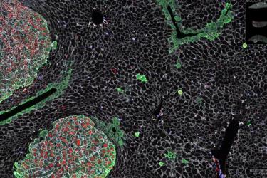 A microscopy image showing tumour cells stained with fluorescent dye.