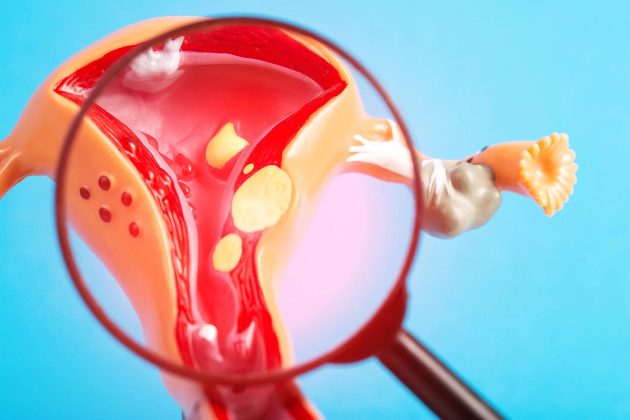 A graphical illustration of a magnifying glass looking at a uterus with cancer growing in it