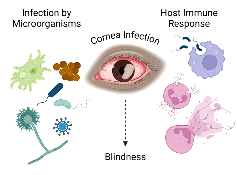 diagram showing that a cornea infection causing blindness is resultant on a microorganism entering the eye and the body's host immune response. 