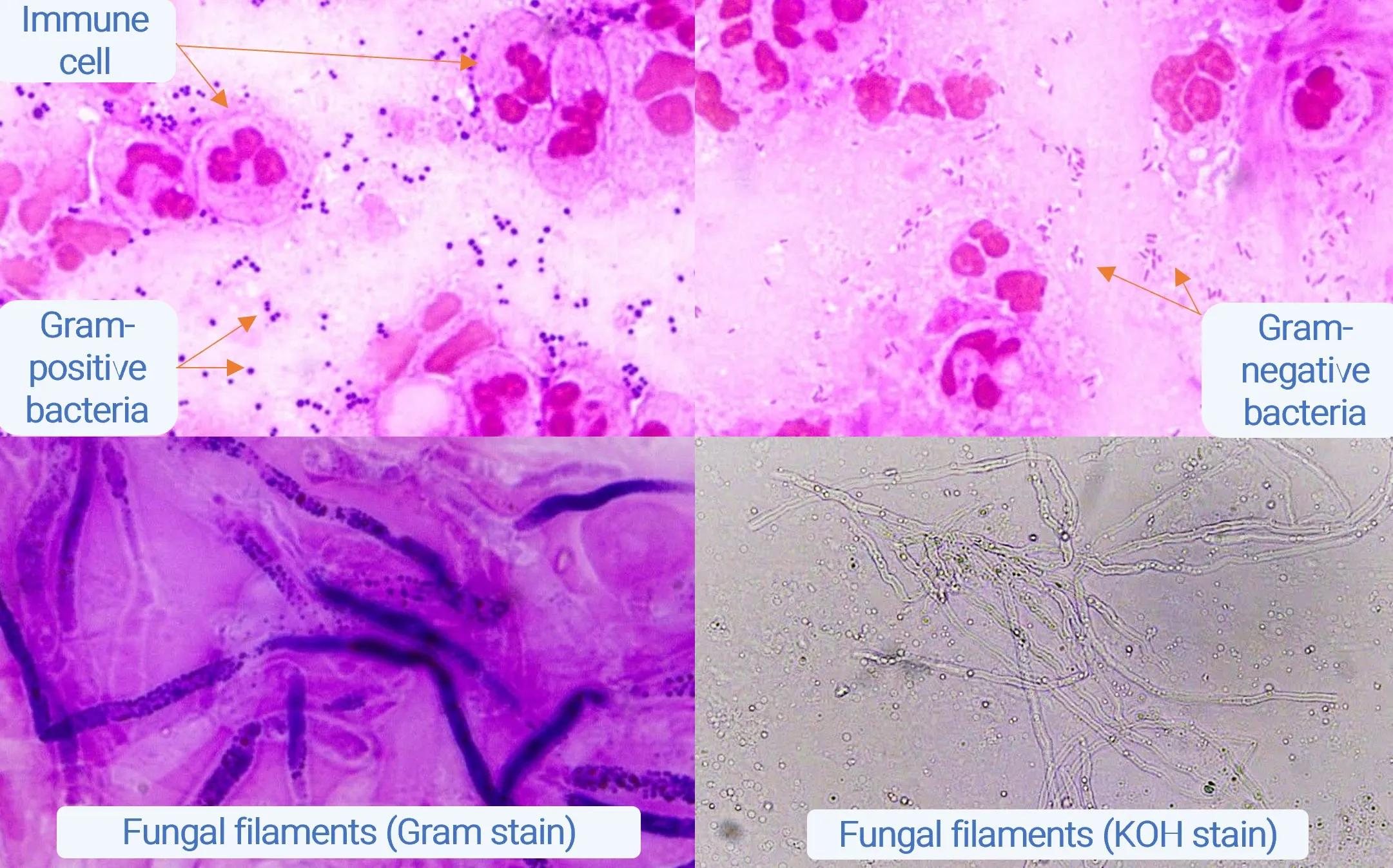 4 images of microscopy stains, with pink, purple and grey dyes showing bacteria or fungi.