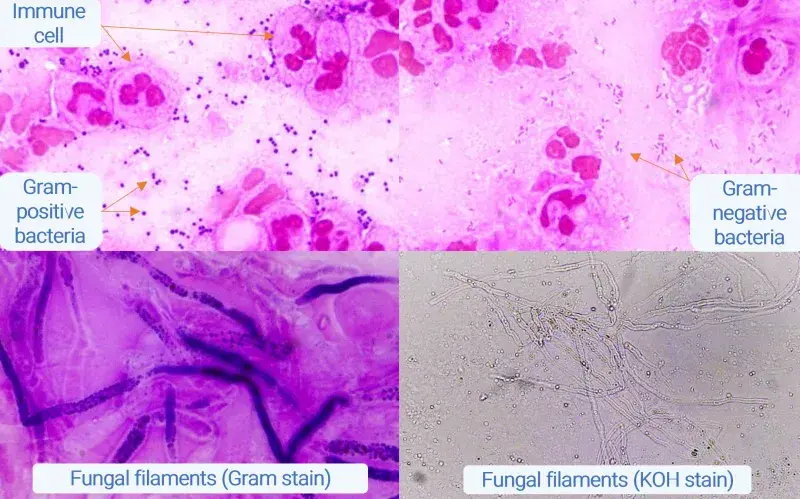 4 images of microscopy stains, with pink, purple and grey dyes showing bacteria or fungi.