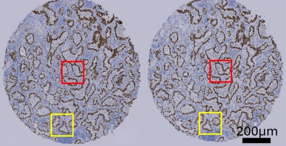 Two circles (patient sample on left and AI-generated image on right). Almost identical, showing blue staining in patterns on tissue