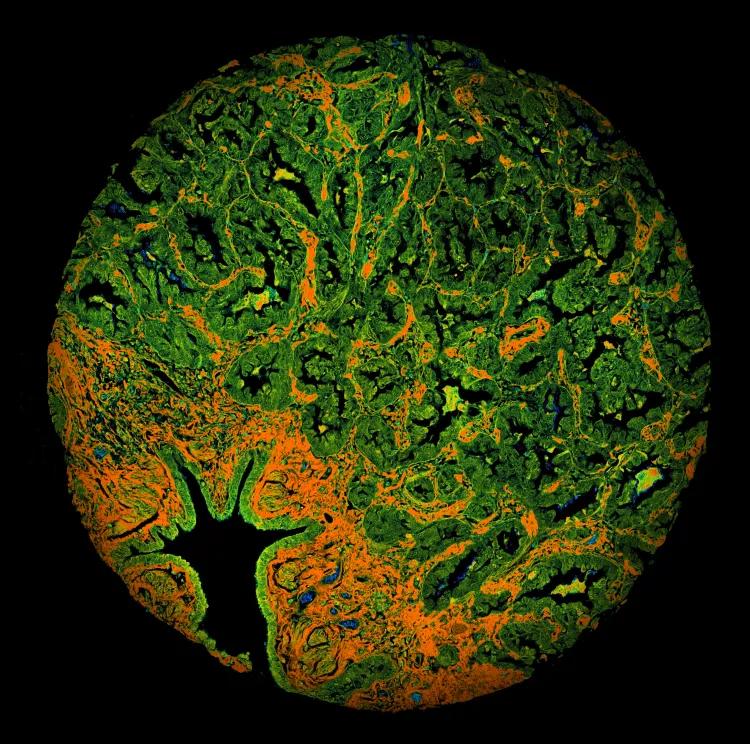 a fluorescent image of lung cancer cells