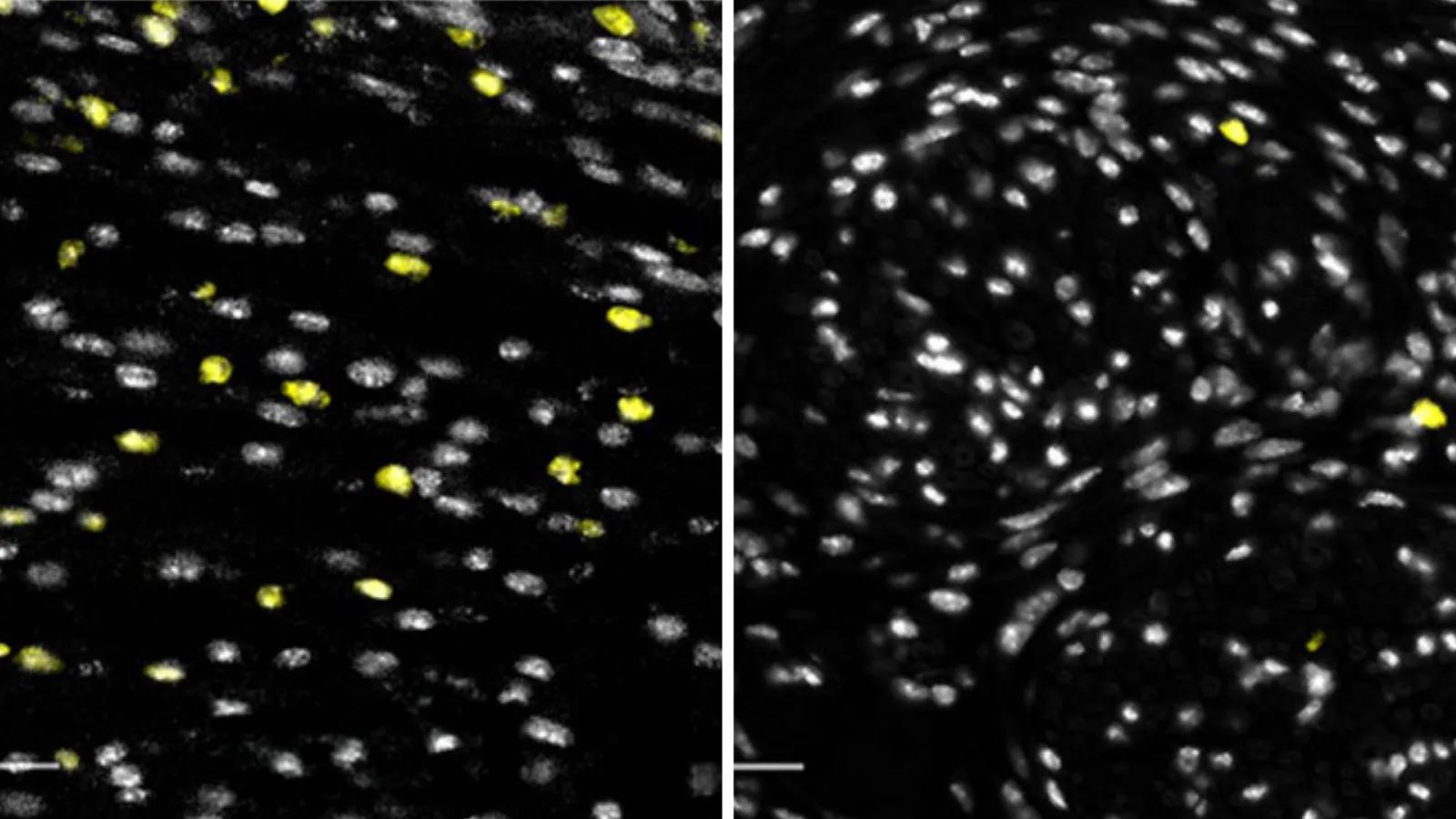 Microscopy image showing small white dots (cells) within a wound site. There is a reduction in wound neutrophil (yellow dots) infiltration in wounds treated with CCL3 blocker (right) compared to those without CCL3 blocker (left).