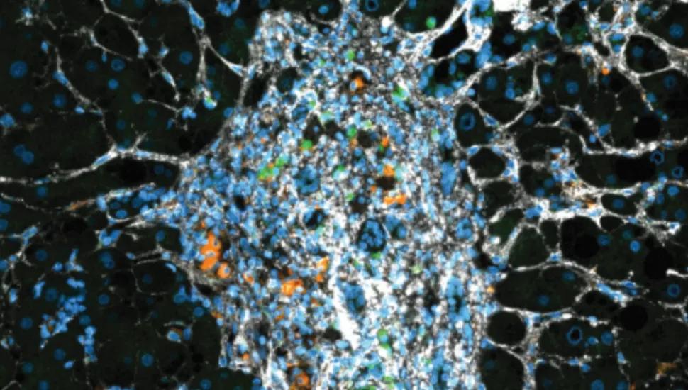 Microscopy image of liver fibrotic tissue showing two subgroups of macrophage immune cells producing either OLR1 (green) or GPNMB (orange) proteins. This study finds that OLR1 macrophages are pro-inflammatory, accumulate in chronic liver disease fibrotic tissue and predict liver disease progression. 