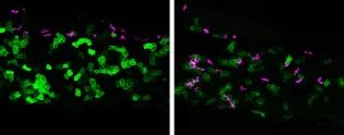 Fluorescent microscopy slides. Image on left as bright magenta cells collecting at the top of the skin's surface). Image on right shows these magenta cells have migrated down amongst the green skin cells.